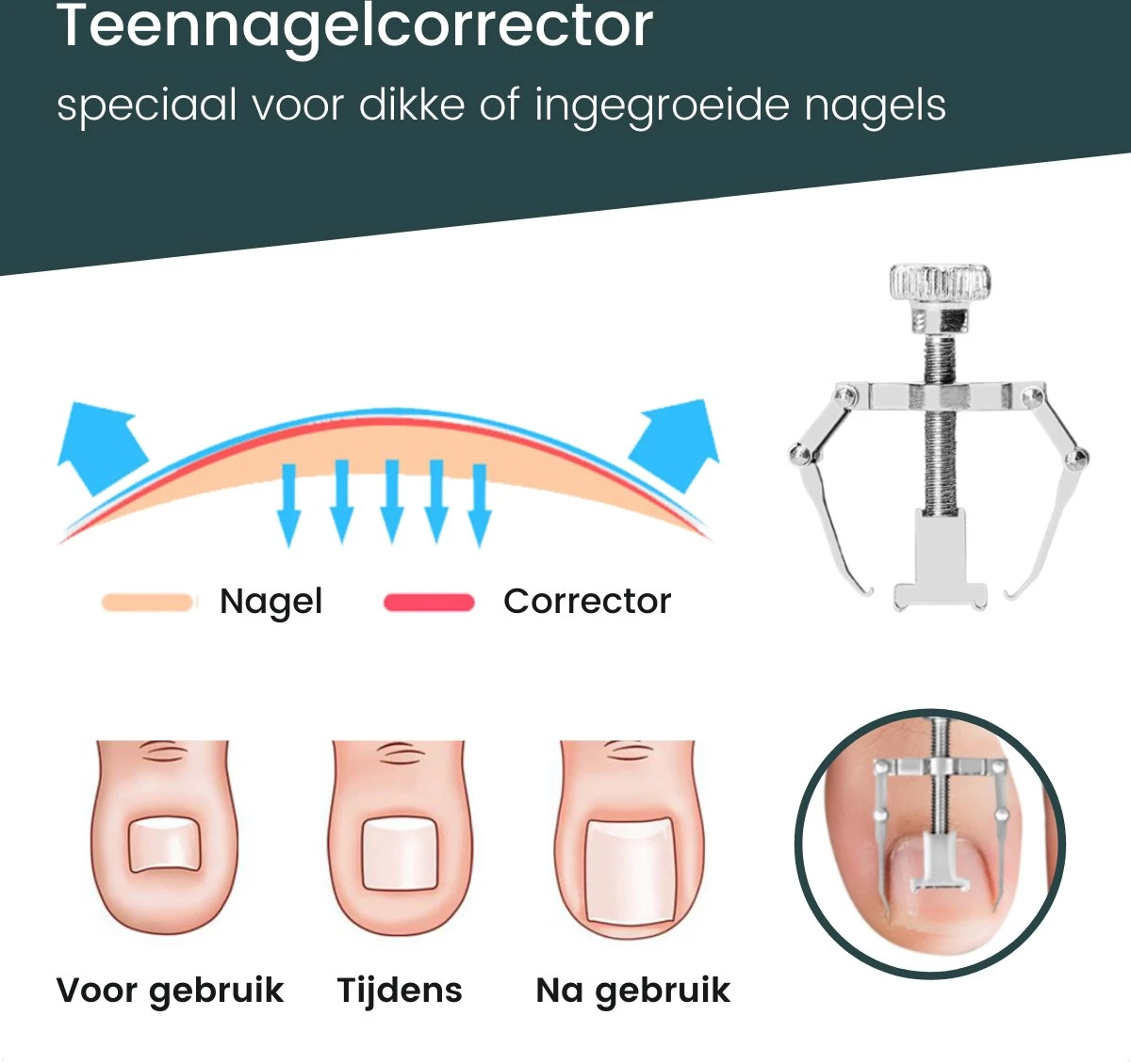 7-Delige Pedicure Set - Nagelverzorging - Nagelset Starterset - Ingegroeide Teennagel - Kalknagelproducten - Pedicuresets - RVS 10 7-Delige Pedicure Set - Nagelverzorging - Nagelset Starterset - Ingegroeide Teennagel - Kalknagelproducten - Pedicuresets - RVS - Afbeelding 8